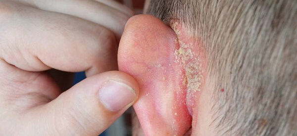 dermatita seboreica ureche